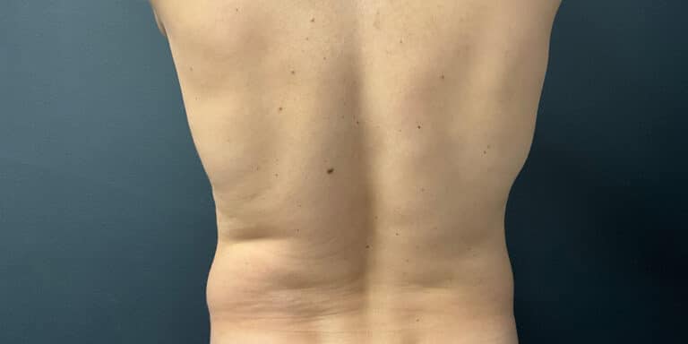 Before Image: Liposuction of the Abdomen and Flanks - back