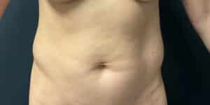 Before Image: Liposuction of the Abdomen and Flanks