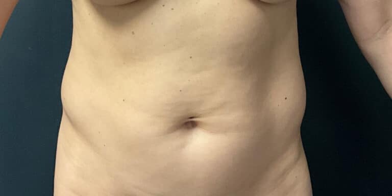 Before Image: Liposuction of the Abdomen and Flanks - front