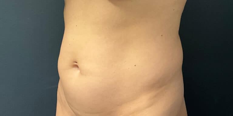 Before Image: Liposuction of the Abdomen and Flanks - left-front-oblique