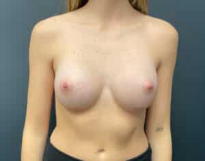 After Image: Breast Augmentation: Mentor Smooth Moderate Plus Xtra (L 325cc R 295cc) Silicone Implants