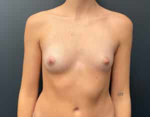 Before Image: Breast Augmentation: Mentor Smooth Moderate Plus Xtra (L 325cc R 295cc) Silicone Implants
