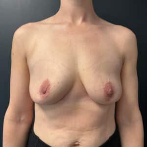 After Image: Bilateral Total Capsulectomy with Breast Implant Removal