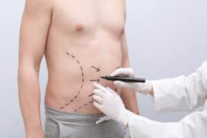 Doctor marking up man's abdomen to prepare for liposuction.