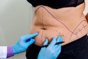 Doctor marking woman's stomach before tummy tuck
