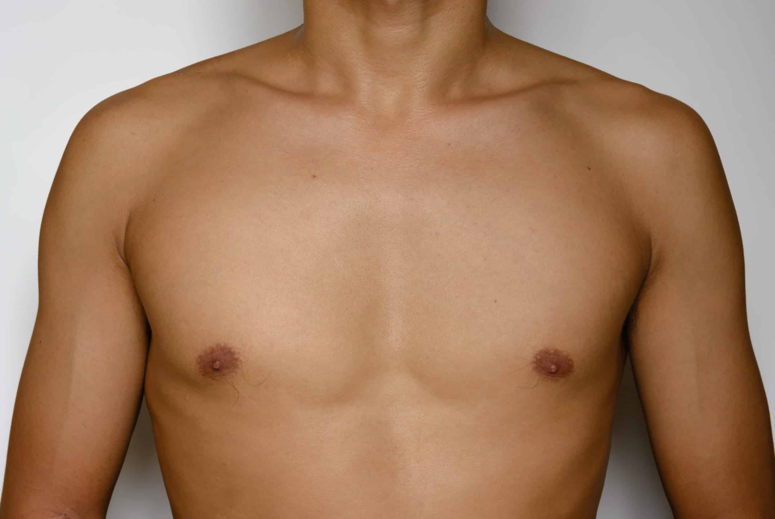 Close-up of a man's bare chest showing proportionate nipple shape and size after nipple reduction surgery