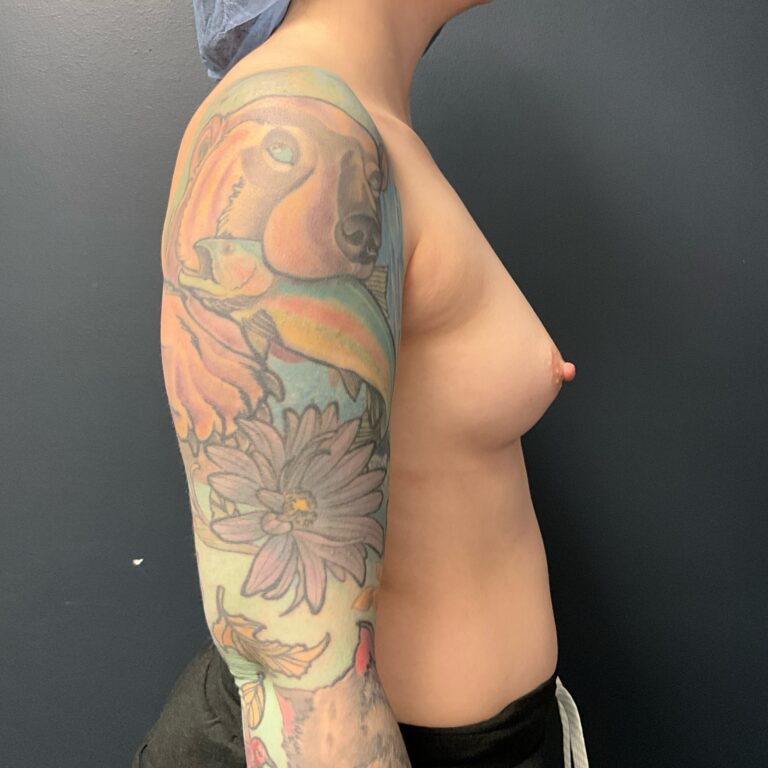 Before Image: Breast Augmentation: Mentor Smooth Moderate Plus Xtra (L 370cc R 405cc) Silicone Implants - right-side
