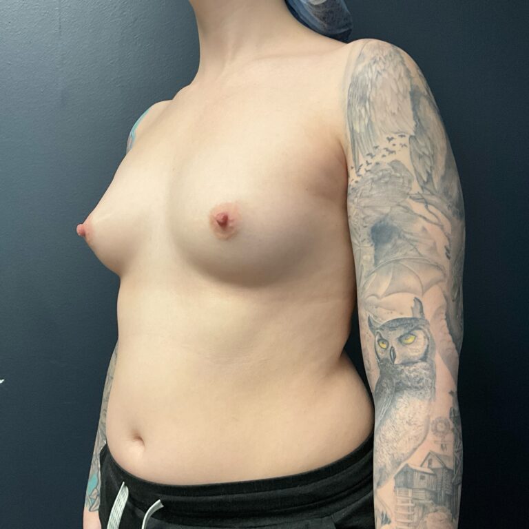 Before Image: Breast Augmentation: Mentor Smooth Moderate Plus Xtra (L 370cc R 405cc) Silicone Implants - left-front-oblique