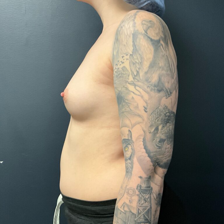 Before Image: Breast Augmentation: Mentor Smooth Moderate Plus Xtra (L 370cc R 405cc) Silicone Implants - left-side