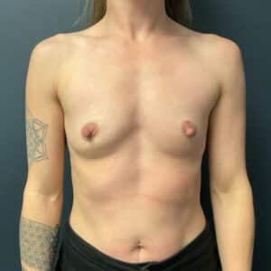 Before Image: Breast Augmentation: Mentor Smooth Moderate Plus Xtra 350cc Silicone Implants