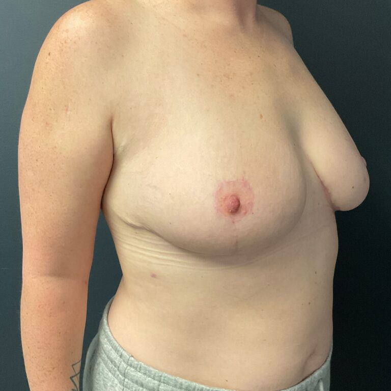 After Image: Cosmetic Breast Reduction - right-front-oblique