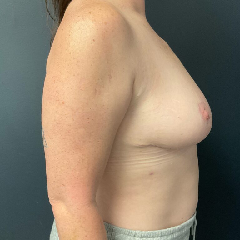 After Image: Cosmetic Breast Reduction - right-side