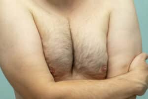 Image of a man's chest with slightly oversized breasts