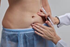 Doctor marking up a woman's stomach to prepare for abdominoplasty/tummy tuck surgery.