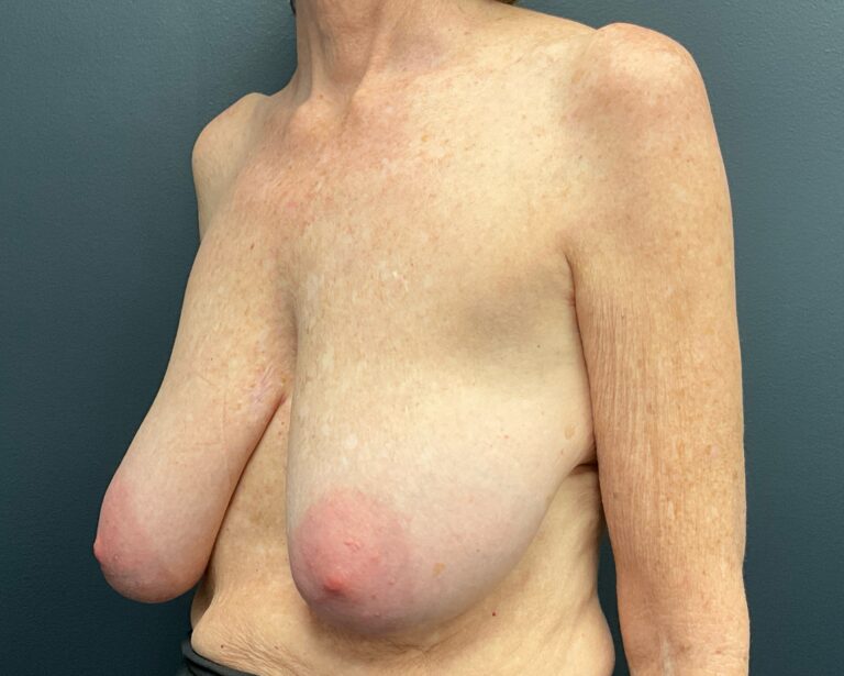 Before Image: Breast Lift (Mastopexy) - left-front-oblique