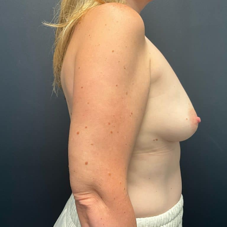 Before Image: Bilateral mastectomy with tissue expanders; silicone implant exchange - right-side
