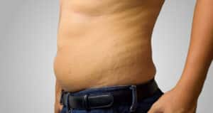 Close-up of an abdomen with visible stretch marks and loose skin.