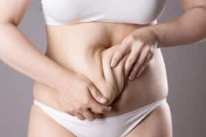 Woman pulling her loose abdominal skin that could be addressed with tummy tuck