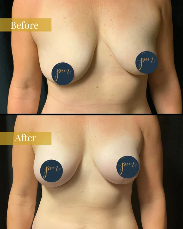 Lifted, fuller, and beautifully balanced.

A breast lift with augmentation combines two powerful procedures: the lift repositions and reshapes sagging breasts, while implants restore lost volume for a youthful, natural-looking contour. Whether due to aging, weight changes, or pregnancy, this procedure can help you feel like you again! 

Click the link in our bio to book your consultation! 

#parkmeadowscosmeticsurgery #cosmeticsurgery #reconstructivesurgery #lonetreeCO #DenverCO